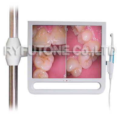 17-inch Monitor HD Intraoral Camera 1/4 SONY CCD HD Oral Camera Module HDMI Input VGA Output Tooth Decay Oral Examination