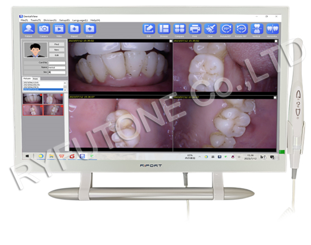 Full HD 21.5inch Intraoral Camera Camputer System with HDMI Dental Caries Oral Examination Oral Health